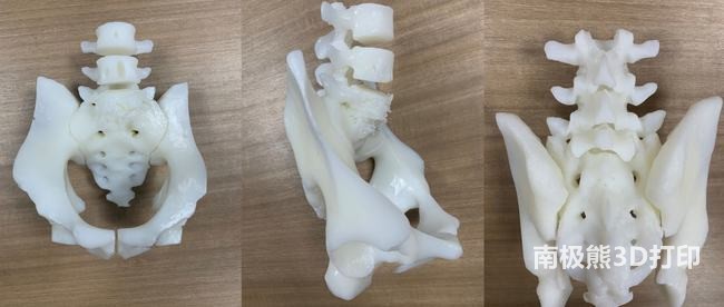 3D打印技術(shù)助力脊柱手術(shù)，讓患者重獲新生